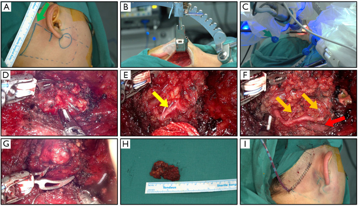 Evaluation of a new developed robotic system for head and neck surgery: a prospective study.