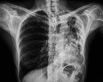Endobronchial Lipoma: A Hidden Obstruction Behind Chronic Cough.