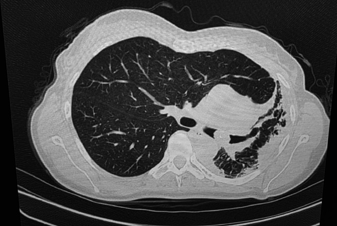 Endobronchial Lipoma: A Hidden Obstruction Behind Chronic Cough.