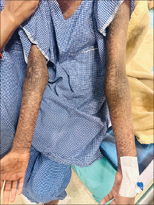 Anesthesia management of patients with ichthyosis vulgaris.