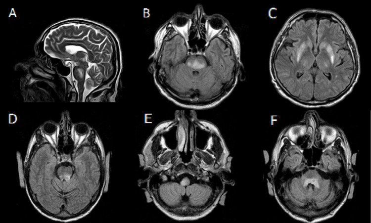 Phenotypic Manifestations in Two Cases of Osmotic Demyelination Syndrome.