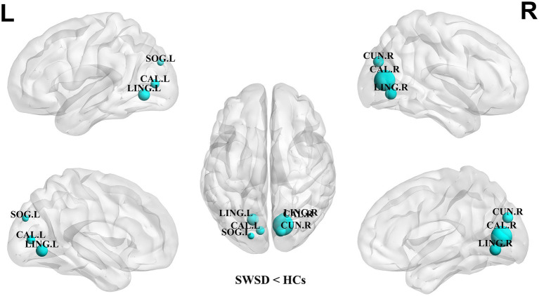 Altered functional network topology and connectivity in female nurses with shift work sleep disorder.