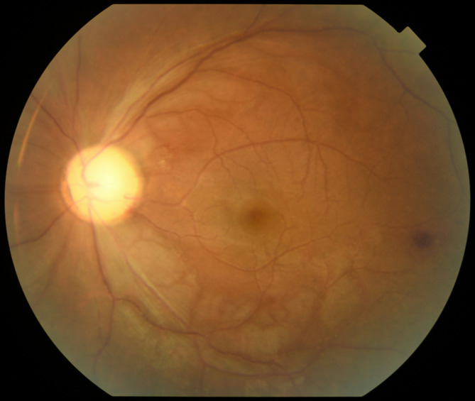 Acute unilateral visual loss as a first presentation of mixed phenotype acute leukaemia.
