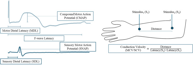 Electrophysiological-based automatic subgroups diagnosis of patients with chronic dysimmune polyneuropathies.