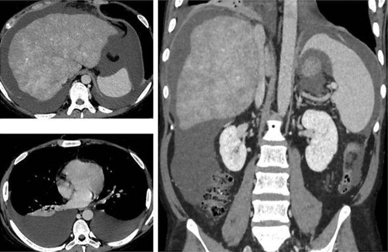 Case Report of Hepatic Sinusoidal Obstruction Syndrome Complicated with Myeloproliferative Neoplasm and Focal Segmental Glomerulosclerosis.