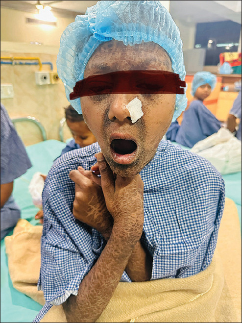 Anesthesia management of patients with ichthyosis vulgaris.