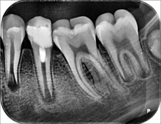 Root development of immature necrotic permanent teeth following regenerative endodontic process: Case series.