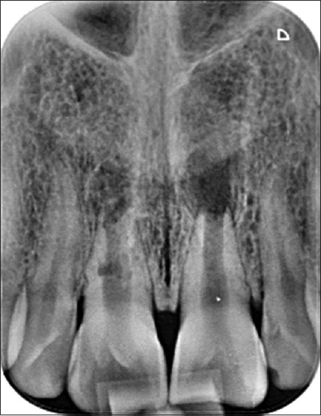 Root development of immature necrotic permanent teeth following regenerative endodontic process: Case series.