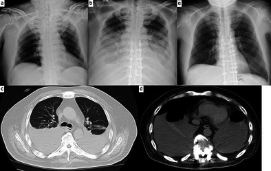 Bilateral Massive Pleural Effusion Caused by Spinal Instability in Diffuse Idiopathic Skeletal Hyperostosis: A Rare but Potentially Serious Complication of Spinal Fracture.