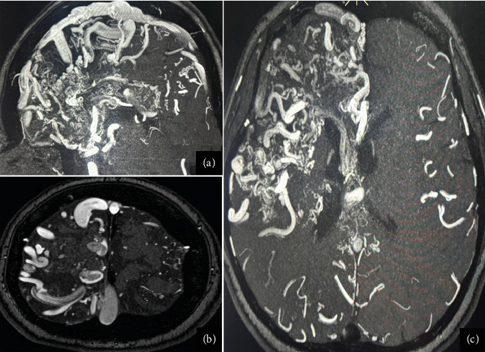 Epilepsy Secondary to a Giant AVM: A Case Report.