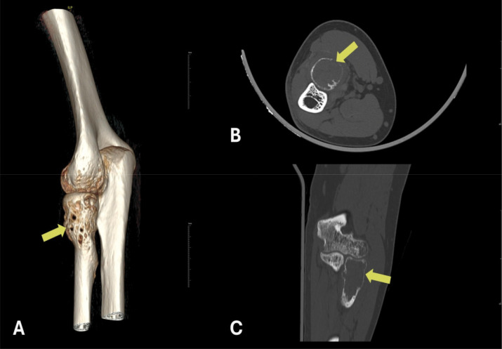 A Rare Subtype in an Uncommon Location: Multimodal Radiologic and Histopathologic Evaluation of a Solid Variant Aneurysmal Bone Cyst in the Radial Head.