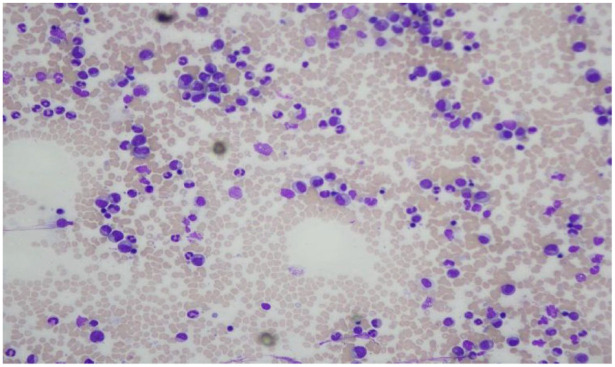 Chronic myeloid leukemia in a patient with beta thalassemia major: a rare presentation.