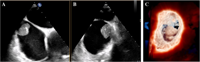 Cardiac tumors: clinical presentation, diagnosis, reatment, and results.