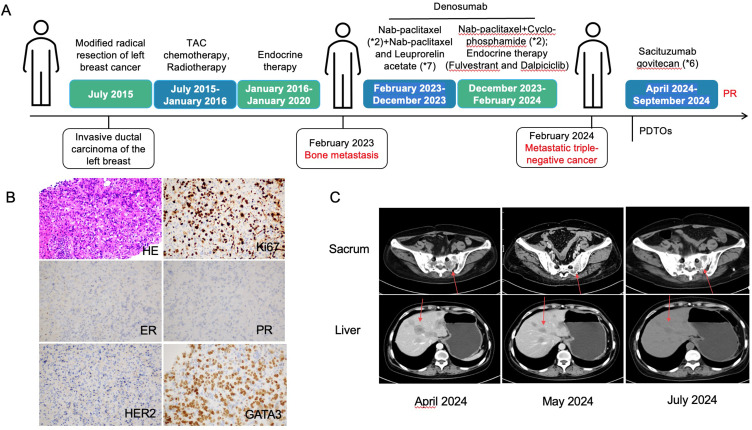 Partial Response Achieved in a Case of Metastatic Triple-Negative Breast Cancer Based on the Patient-Derived Tumor Organoids.