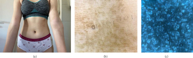 Terra Firma-Forme Dermatosis: Clinical Insights, Dermoscopic and Ultraviolet-Induced Fluorescence Dermoscopy Findings-A Case Report and Literature Review.