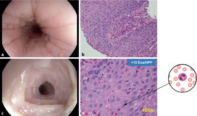 [Eosinophilic esophagitis-an underestimated food allergy?]