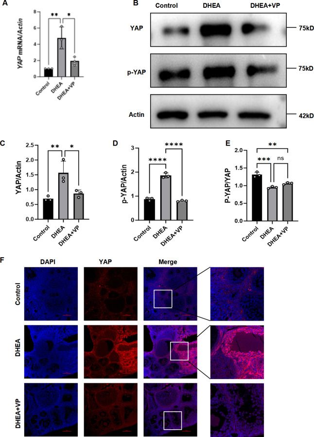 Hyperandrogenism-mediated YAP activation drives ovarian inflammation and pyroptosis in PCOS: implications for follicular dysfunction.