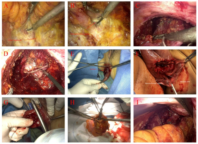 Perioperative safety evaluation of intersphincteric resection combined with rectal eversion and total extra-abdominal resection: a prospective randomized controlled trial.