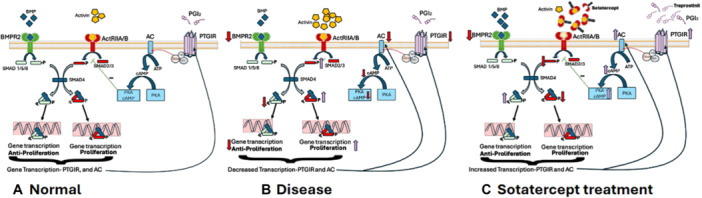 Pericardial Effusion and Prostacyclin Analog Toxicity After Initiation of Sotatercept.