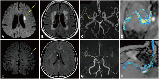 Geometry and Wall Shear Stress of the Contralesional Middle Cerebral Artery Are Associated With the Burden of Cerebral Small Vessel Disease in Acute Ischemic Stroke.