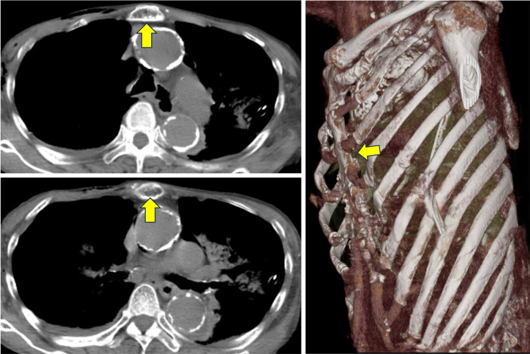 Application of the Nuss procedure for flail chest following cardiopulmonary resuscitation: a case report.
