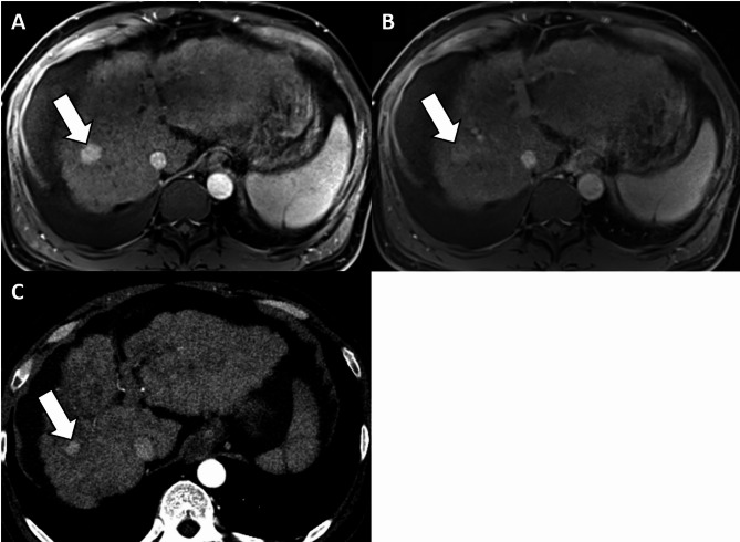 Value of threshold growth for the diagnosis of hepatocellular carcinoma using LI-RADS.