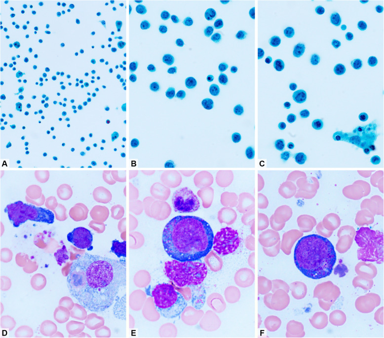 Effusion cytology of EBV-associated lymphoma: a concise review.