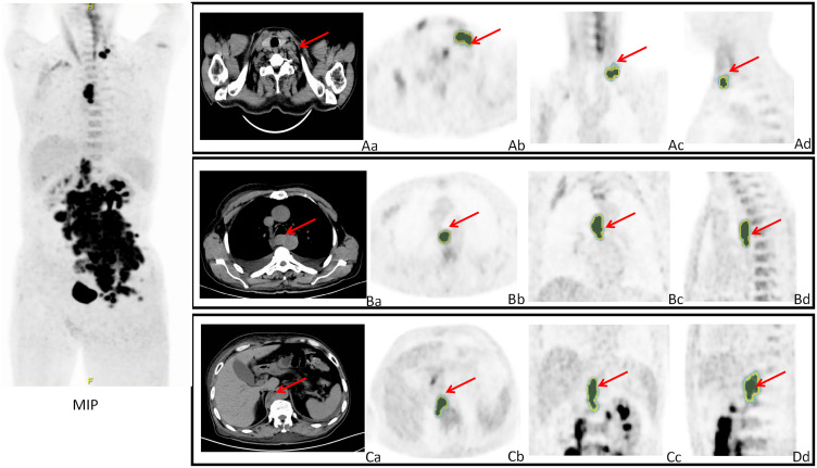 The Role of Artificial Intelligence and Radiomics in the Management of Lymphomas by PET/CT: The Clairvoyance in Clinic.