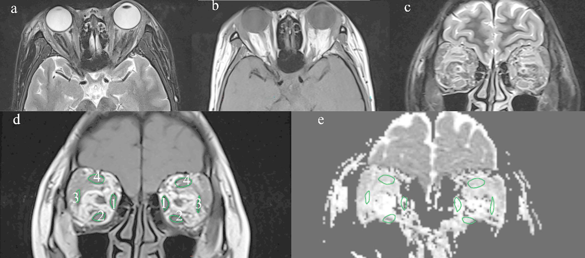 Apparent diffusion coefficient: a predictor of the efficacy of glucocorticoid therapy in active moderate-severe thyroid eye disease: a retrospective cohort study.