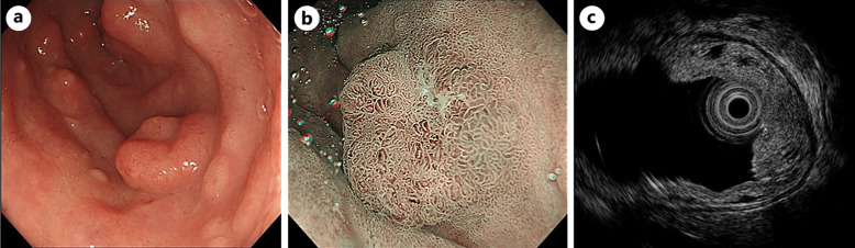 Small Duodenal Adenocarcinoma with Peritoneal Dissemination Mimicking Duodenal Brunner's Gland Hyperplasia.