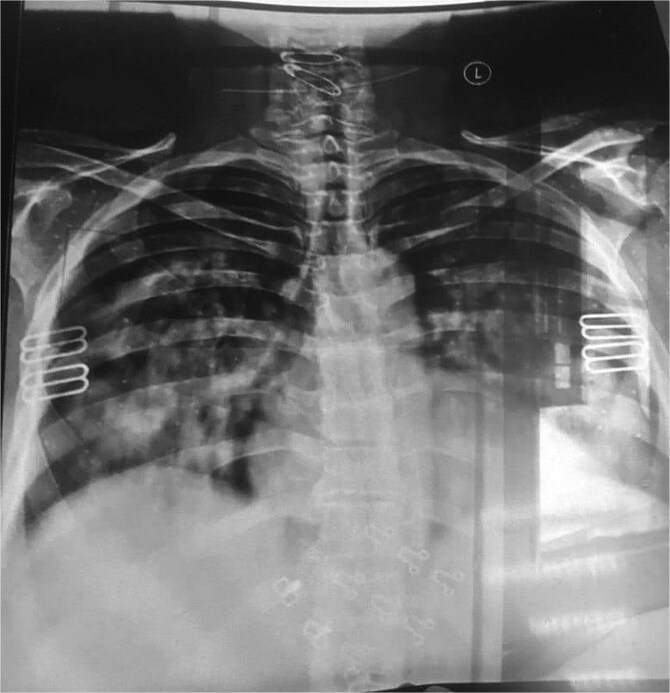Diffuse alveolar Hemorrhage as the initial presentation of systemic lupus erythematosus in a 57-year-old patient: a case report.