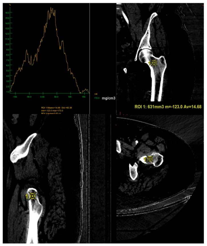 Bone Mineral Density (BMD) Assessment Using Dual-Energy CT with Different Base Material Pairs (BMPs).