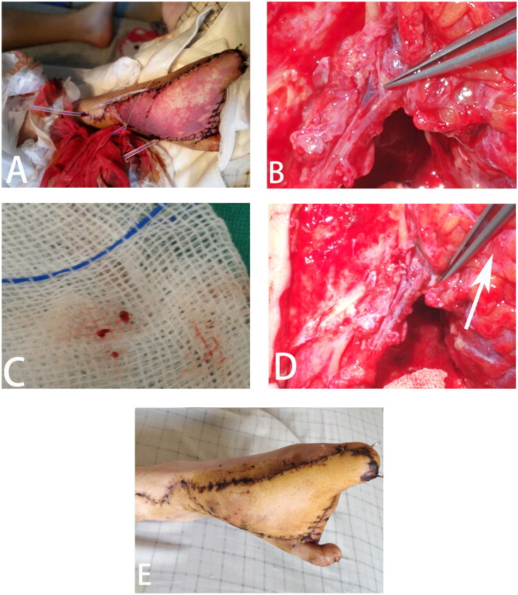 Flap vascular compromise resulting from an embolus not localized within the anastomotic region.