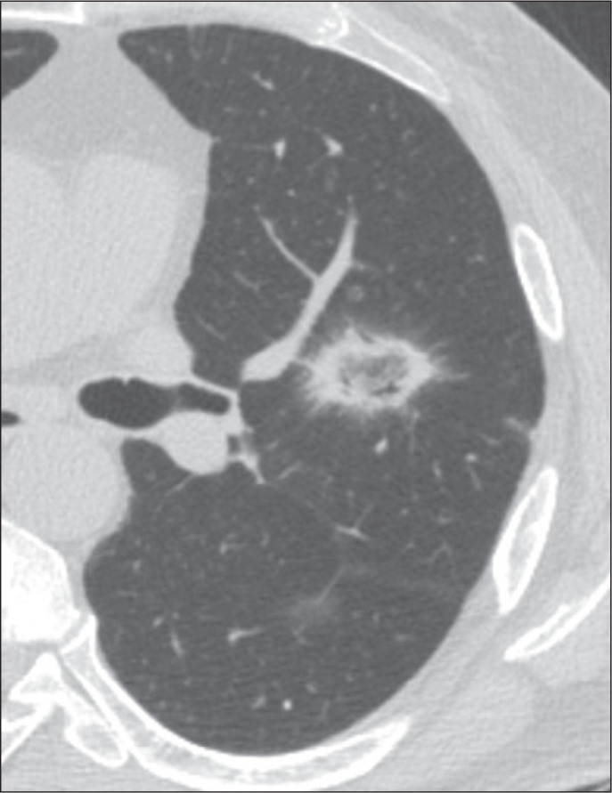 Reversed halo sign on chest computed tomography: a retrospective analysis of 286 cases.