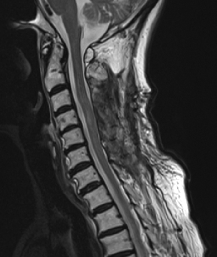 Rapidly Progressive Impaired Consciousness in Cervical Intramedullary Spinal Cord Abscess: A Case Report.