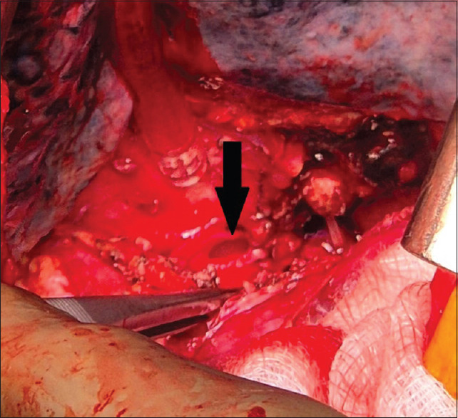 End-Tidal Carbon Dioxide - A Guided Tool to Diagnose a Bronchial Tree Injury in Thoracoscopic Procedures.