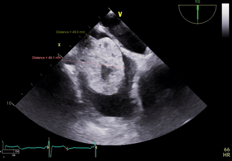 The atrial mass without an auscultatory "plop": renal cell carcinoma presenting with cardiac syncope-a case report.