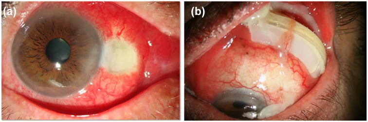 Infectious scleritis: a comprehensive narrative review of epidemiology, clinical characteristics, and management strategies.