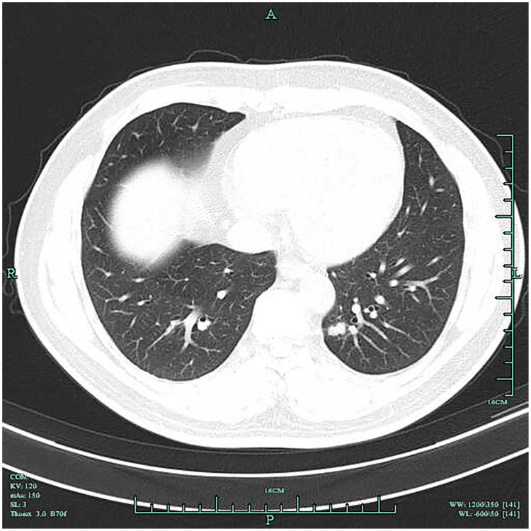 Clinical Value of Low-Dose Spiral CT Combined with Serum CEA in the Differential Diagnosis of Early Lung Cancer.