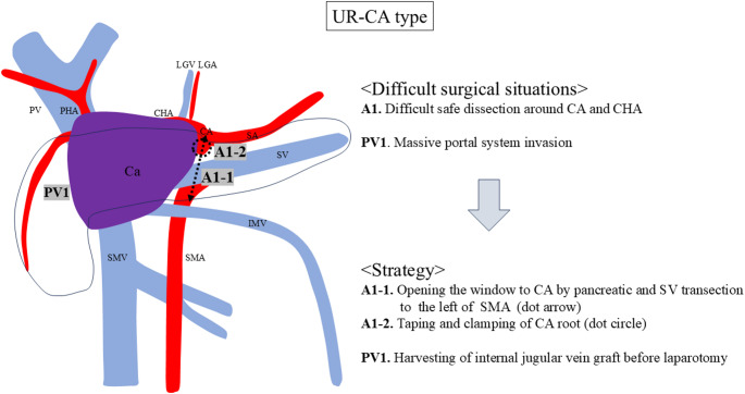 Standardization of surgical procedure for initially unresectable locally advanced pancreatic head cancer.