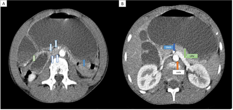 Combined Superior Mesenteric Artery Syndrome and Nutcracker Syndrome in a Young Male Patient Presenting as Atypical Vomiting and Rapid Weight Loss: A Case Report.