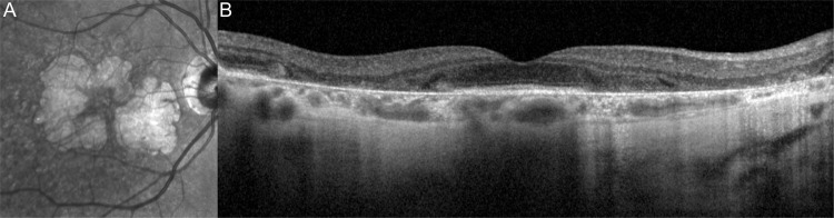 Consideration of patient phenotypes in geographic atrophy due to age-related macular degeneration.