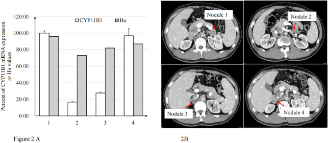 Nodule density on CT-scan correlates with CYP11B1 expression in a patient with ARMC5 mutated primary bilateral macronodular adrenal hyperplasia.