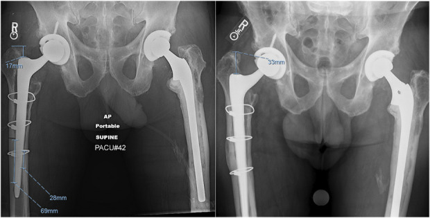 Extended Trochanteric Osteotomy Increases the Risk of Tapered Splined Stem Subsidence in Revision Total Hip Arthroplasty.