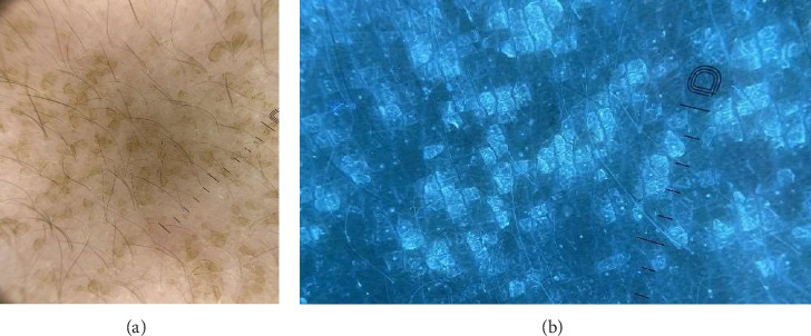 Terra Firma-Forme Dermatosis: Clinical Insights, Dermoscopic and Ultraviolet-Induced Fluorescence Dermoscopy Findings-A Case Report and Literature Review.