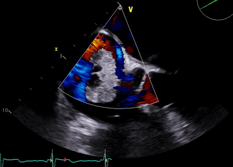 The atrial mass without an auscultatory "plop": renal cell carcinoma presenting with cardiac syncope-a case report.