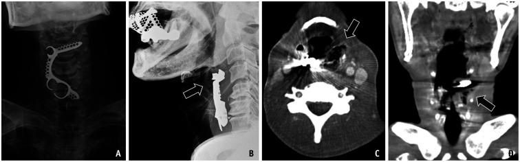 Foreign Body Ingestion: Radiologic Evaluation, Findings, and Management.