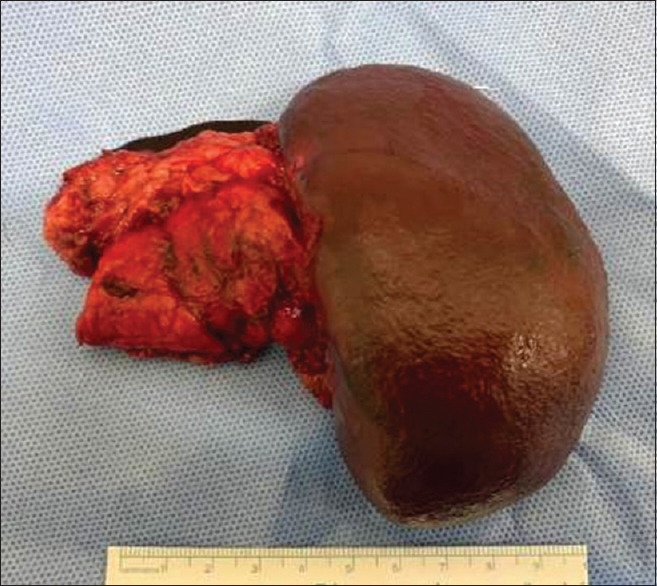 Intrapancreatic accessory spleen mimicking a pancreatic neuroendocrine tumour - An important but almost forgotten differential diagnosis.