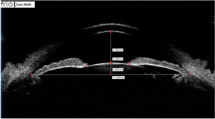 Ultrasound biomicroscopic imaging analysis of lens position and stability in acute and chronic angle-closure glaucoma.