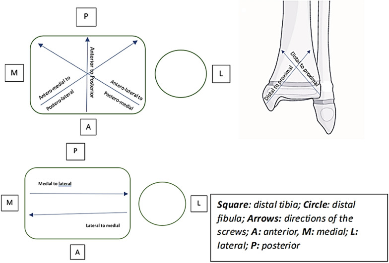 Utility of computed tomography in children's ankle fractures from classification to surgical planning.